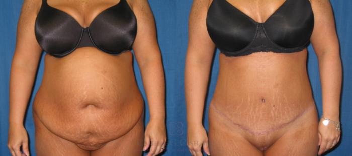 Before & After Tummy Tuck Case 128 View #1 View in Houston, TX