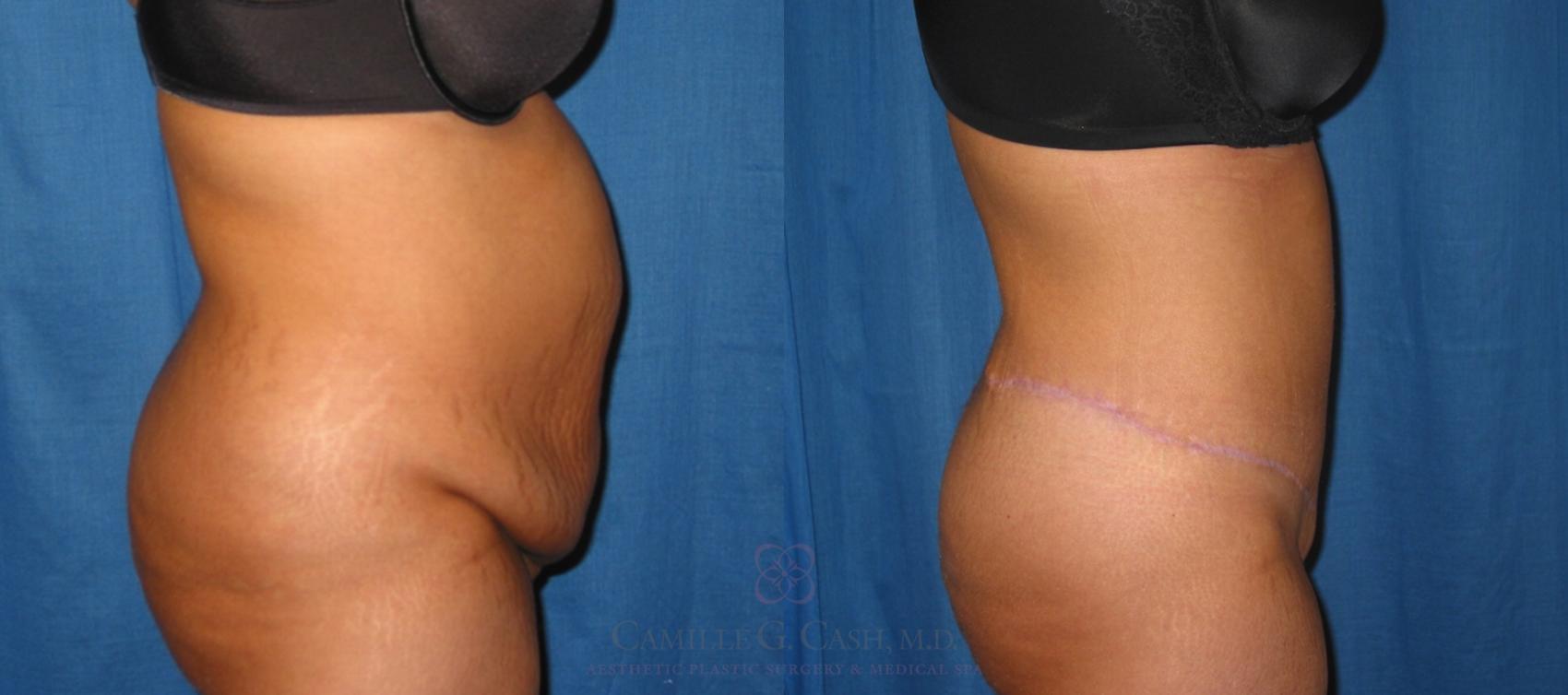 Before & After Tummy Tuck Case 128 View #2 View in Houston, TX
