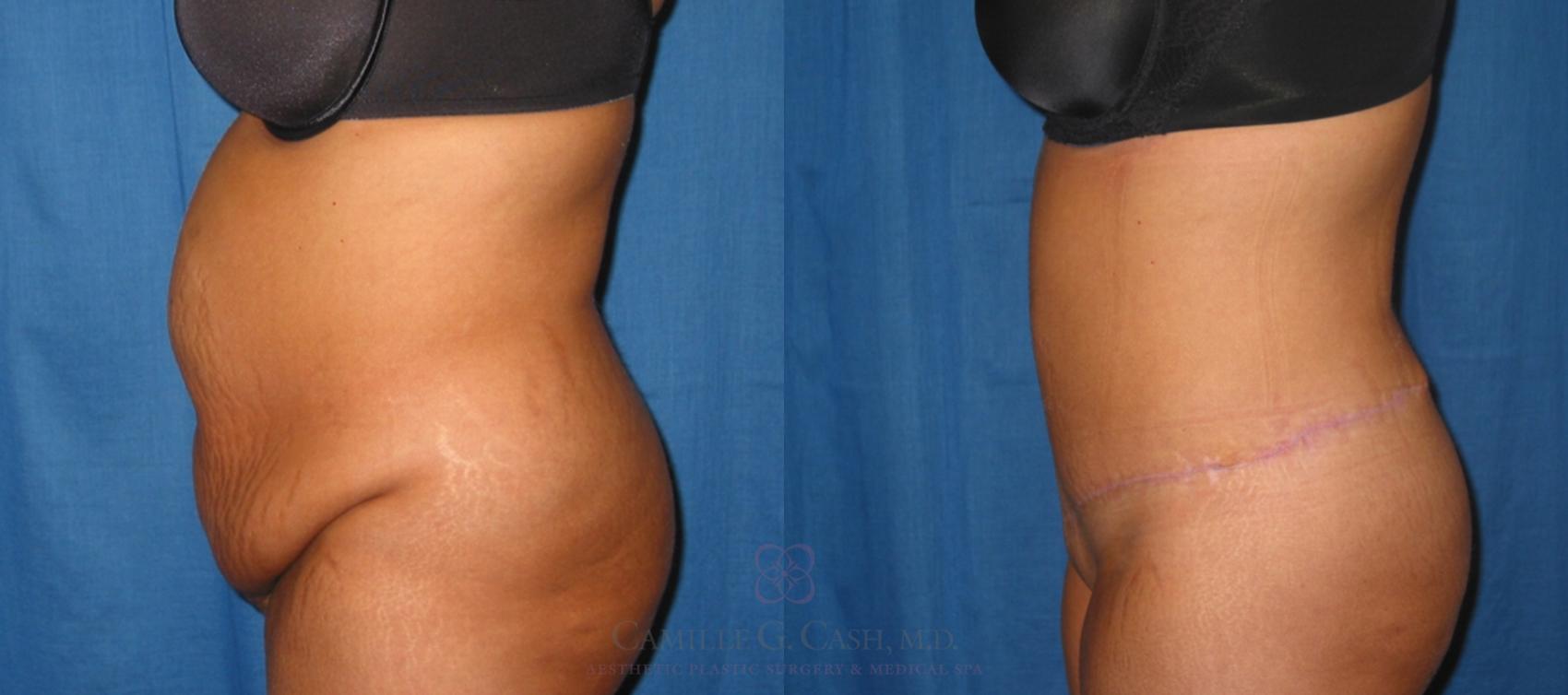 Before & After Tummy Tuck Case 128 View #3 View in Houston, TX