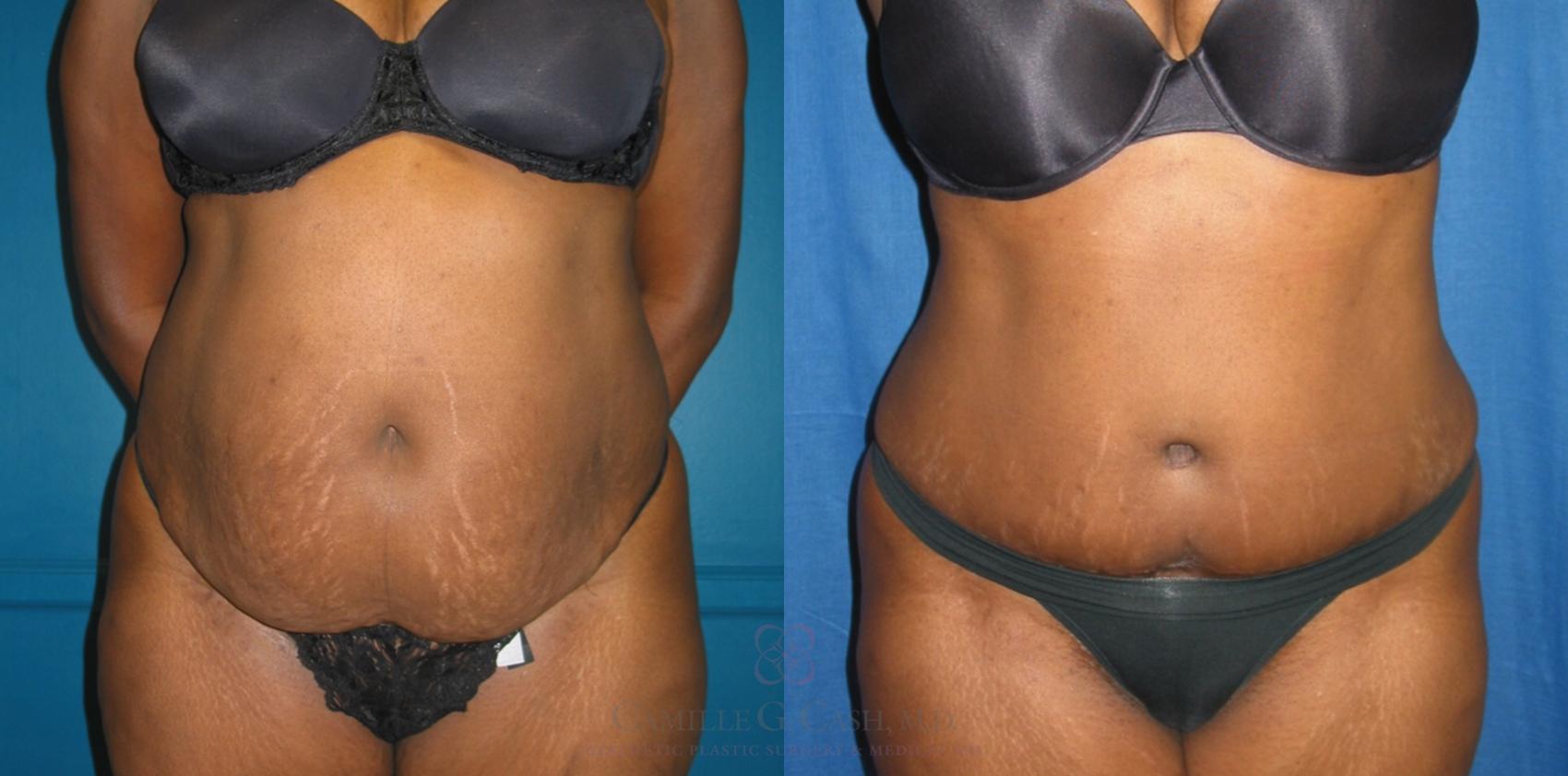 Before & After Tummy Tuck Case 133 View #1 View in Houston, TX