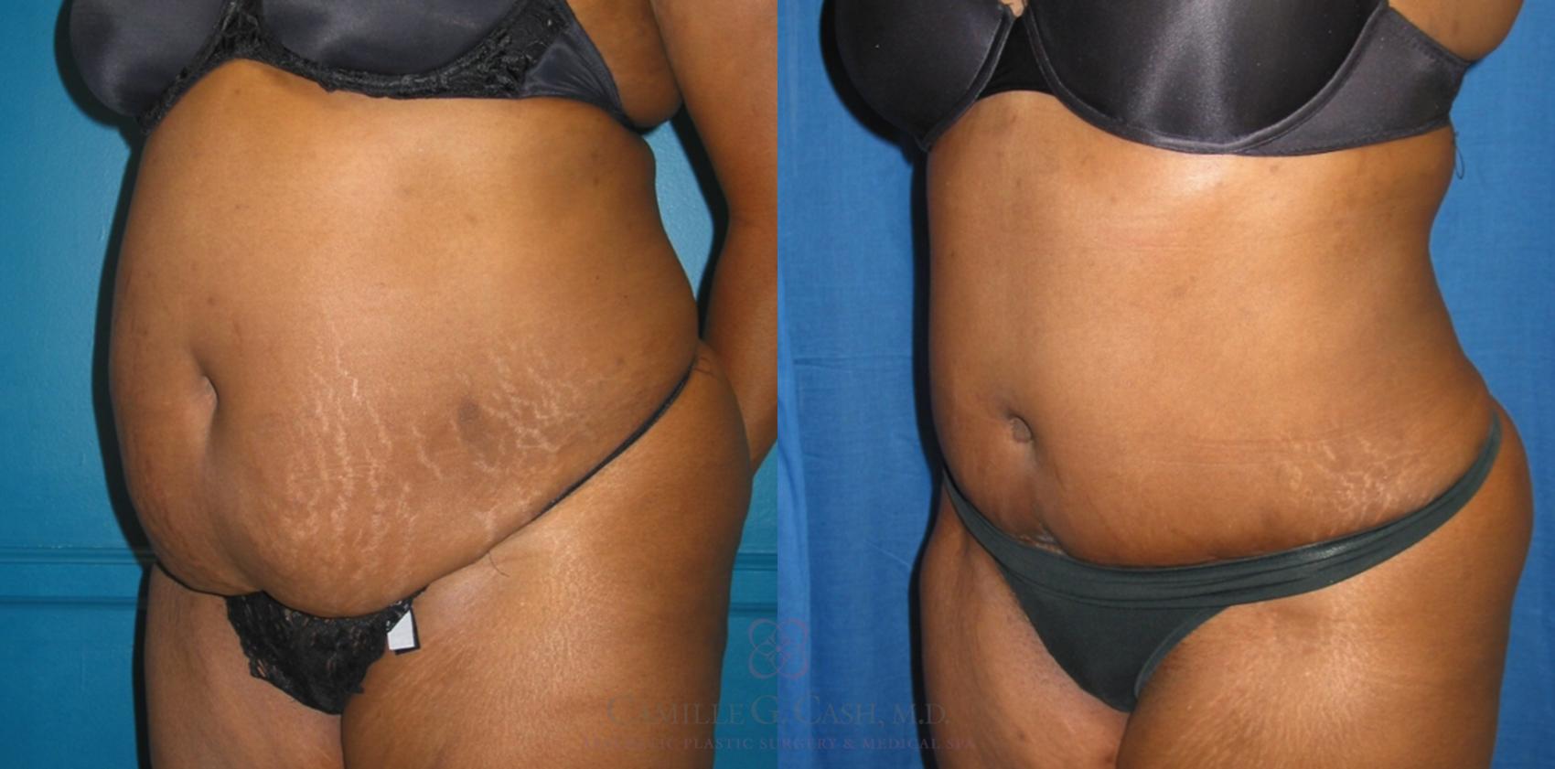 Before & After Tummy Tuck Case 133 View #2 View in Houston, TX