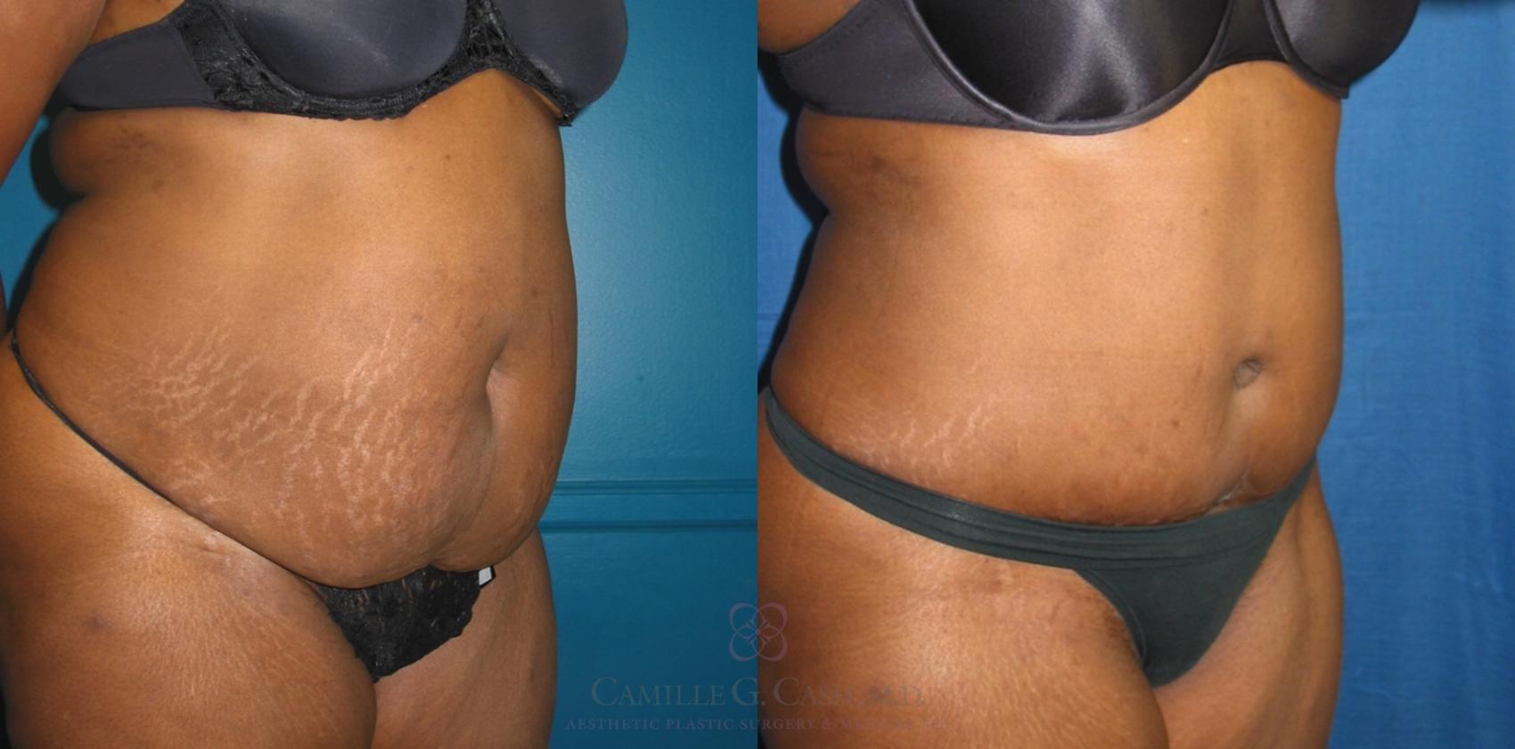 Before & After Tummy Tuck Case 133 View #3 View in Houston, TX