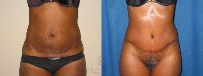 Before & After Tummy Tuck Case 135 Front View in Houston, TX