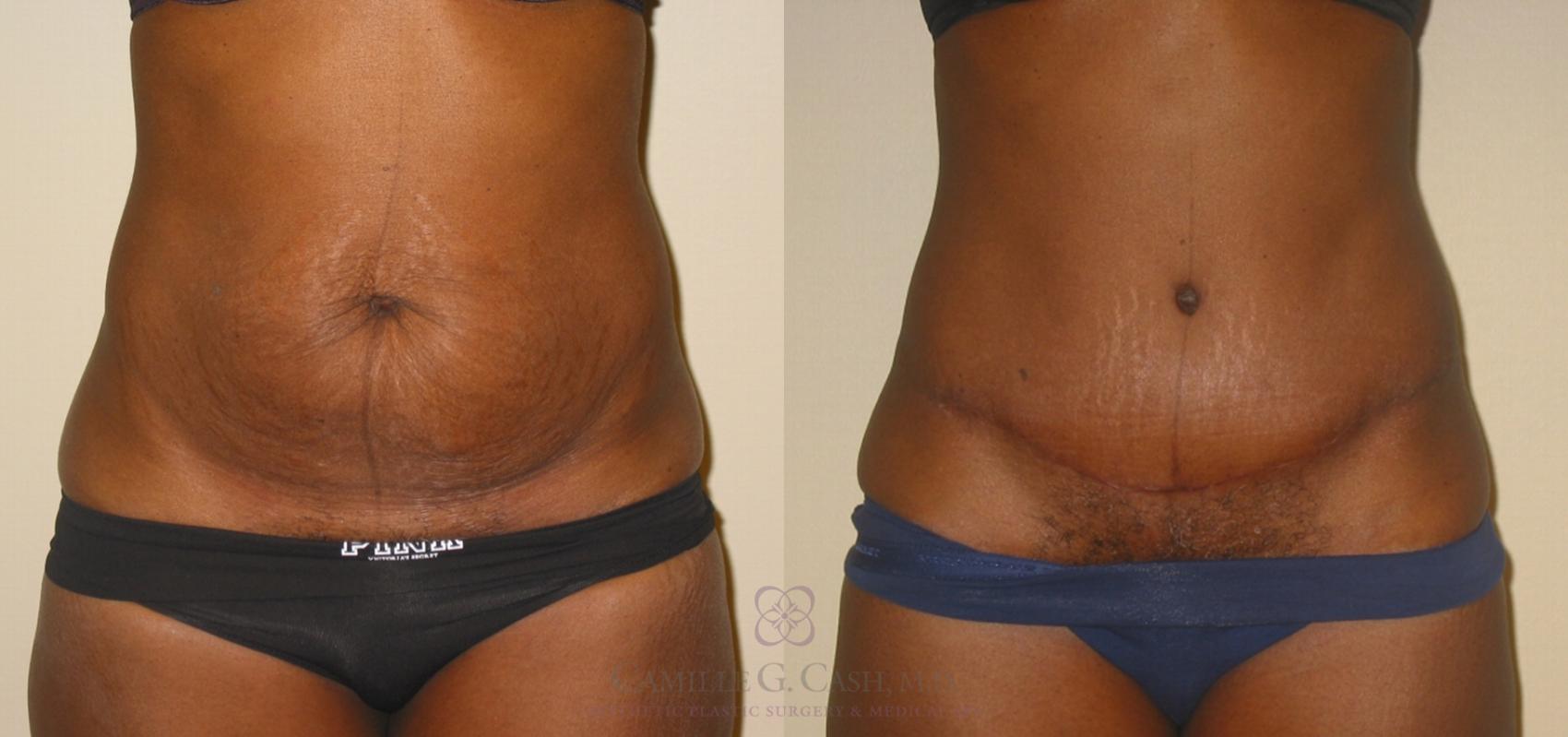 Before & After Tummy Tuck Case 135 View #1 View in Houston, TX