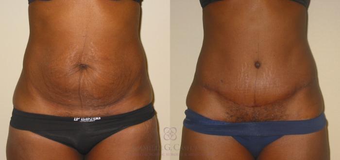 Before & After Tummy Tuck Case 135 View #1 View in Houston, TX