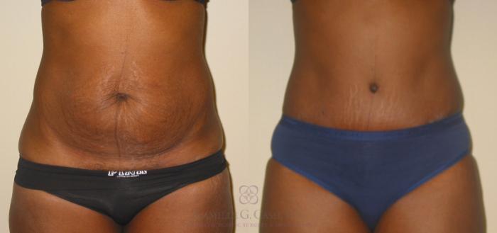 Before & After Tummy Tuck Case 135 View #2 View in Houston, TX