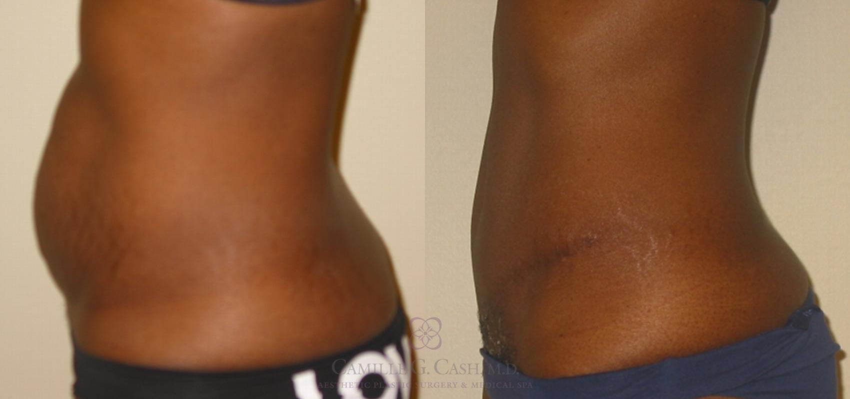 Before & After Tummy Tuck Case 135 View #3 View in Houston, TX