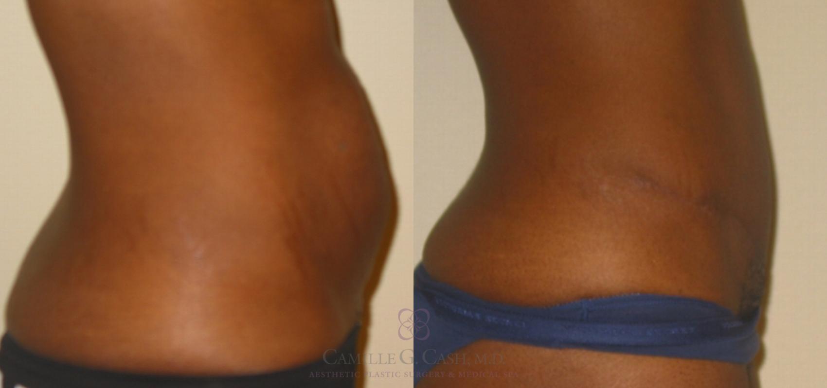 Before & After Tummy Tuck Case 135 View #4 View in Houston, TX