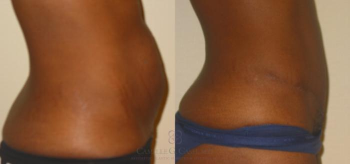 Before & After Tummy Tuck Case 135 View #4 View in Houston, TX