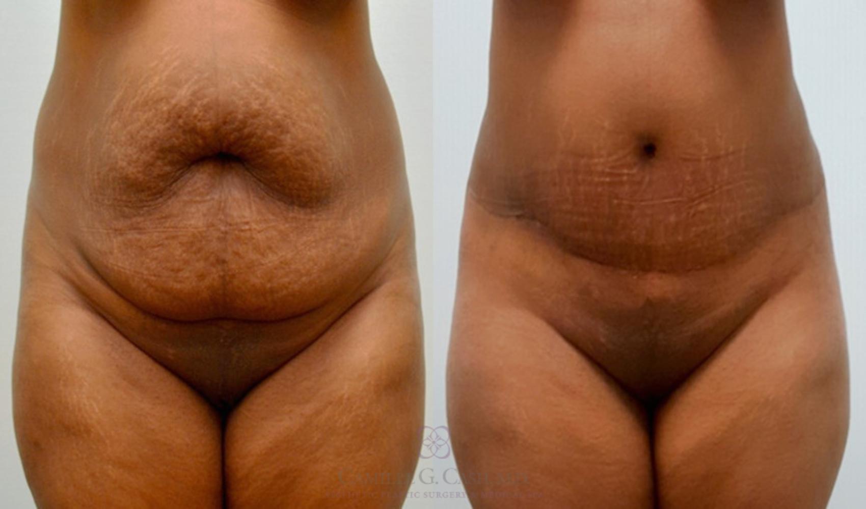 Before & After Tummy Tuck Case 145 View #2 View in Houston, TX