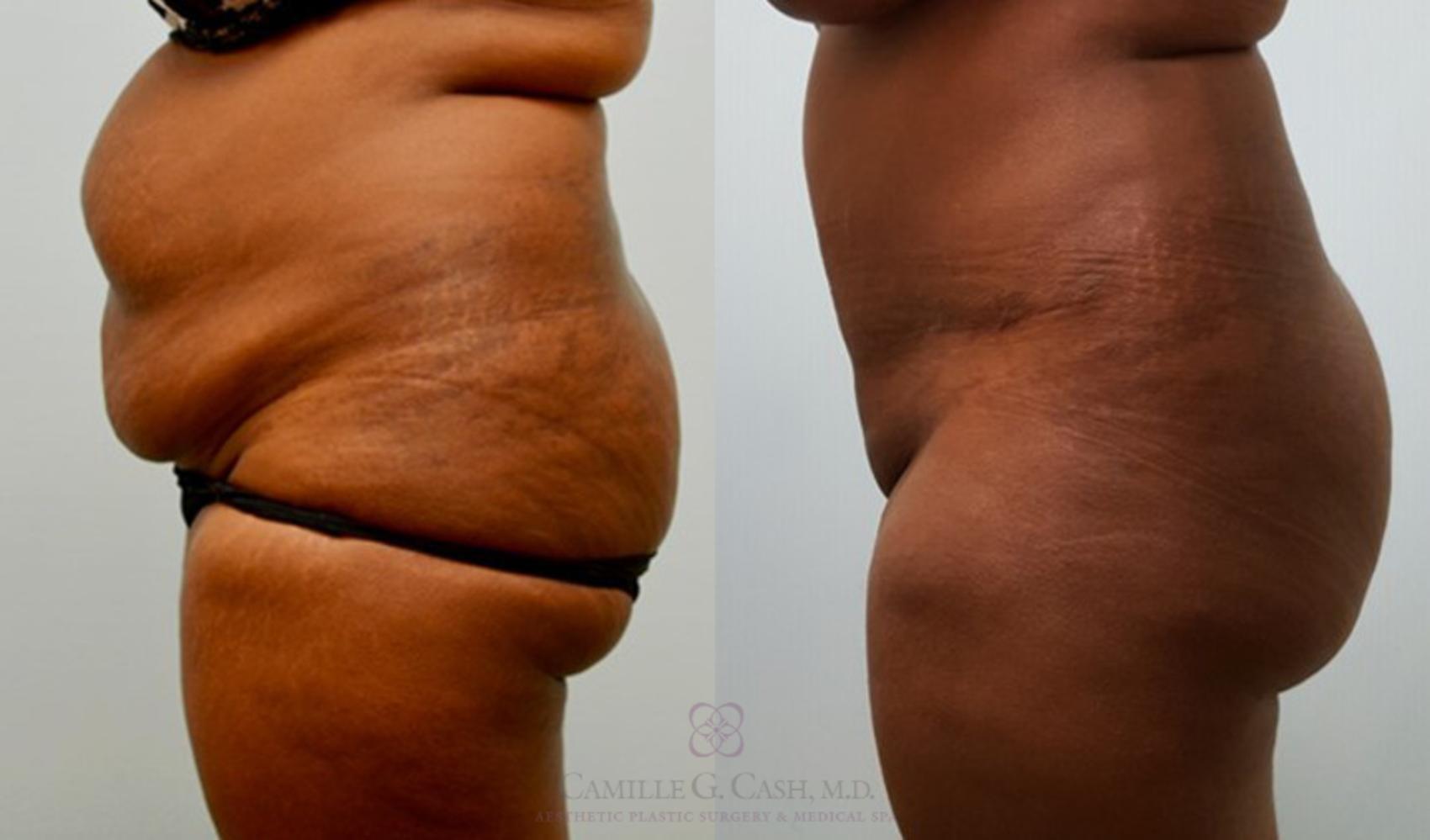 Before & After Tummy Tuck Case 145 View #3 View in Houston, TX