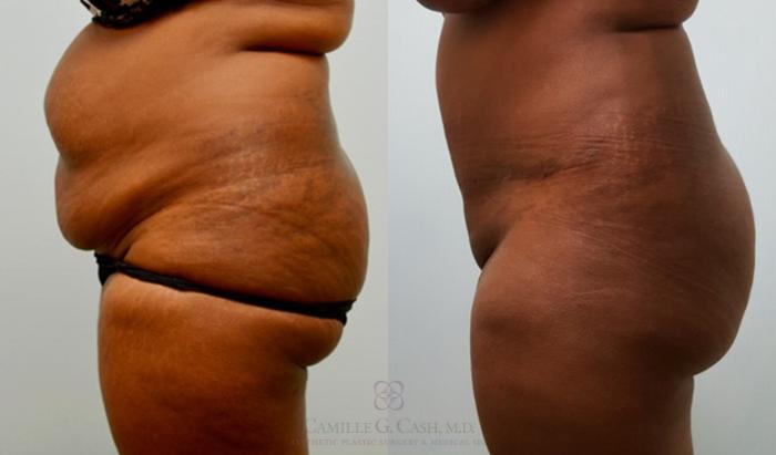 Before & After Tummy Tuck Case 145 View #3 View in Houston, TX