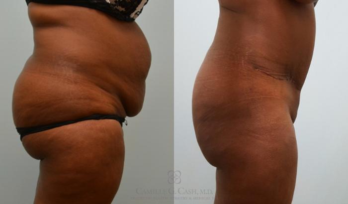 Before & After Tummy Tuck Case 145 View #5 View in Houston, TX