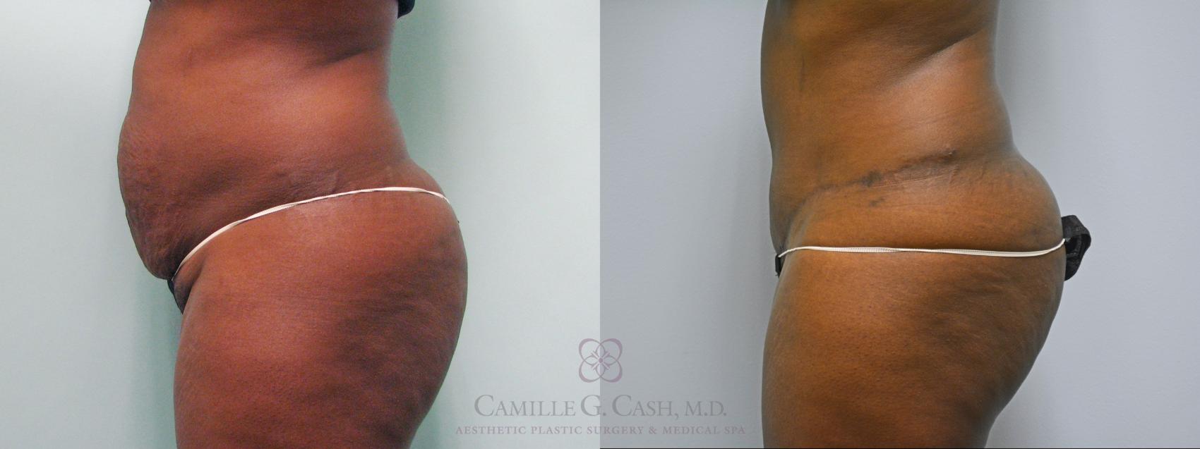Before & After Tummy Tuck Case 179 Right Side View in Houston, TX