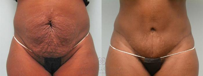Before & After Tummy Tuck Case 179 View #1 View in Houston, TX