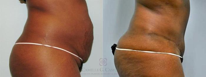 Before & After Tummy Tuck Case 179 View #2 View in Houston, TX