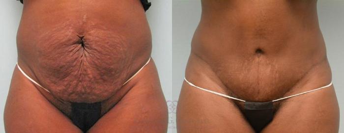Before & After Tummy Tuck Case 179 View #3 View in Houston, TX