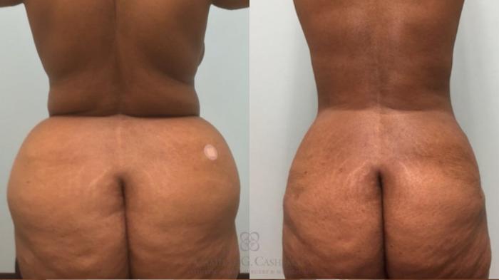 Before & After Tummy Tuck Case 181 back 2 View in Houston, TX