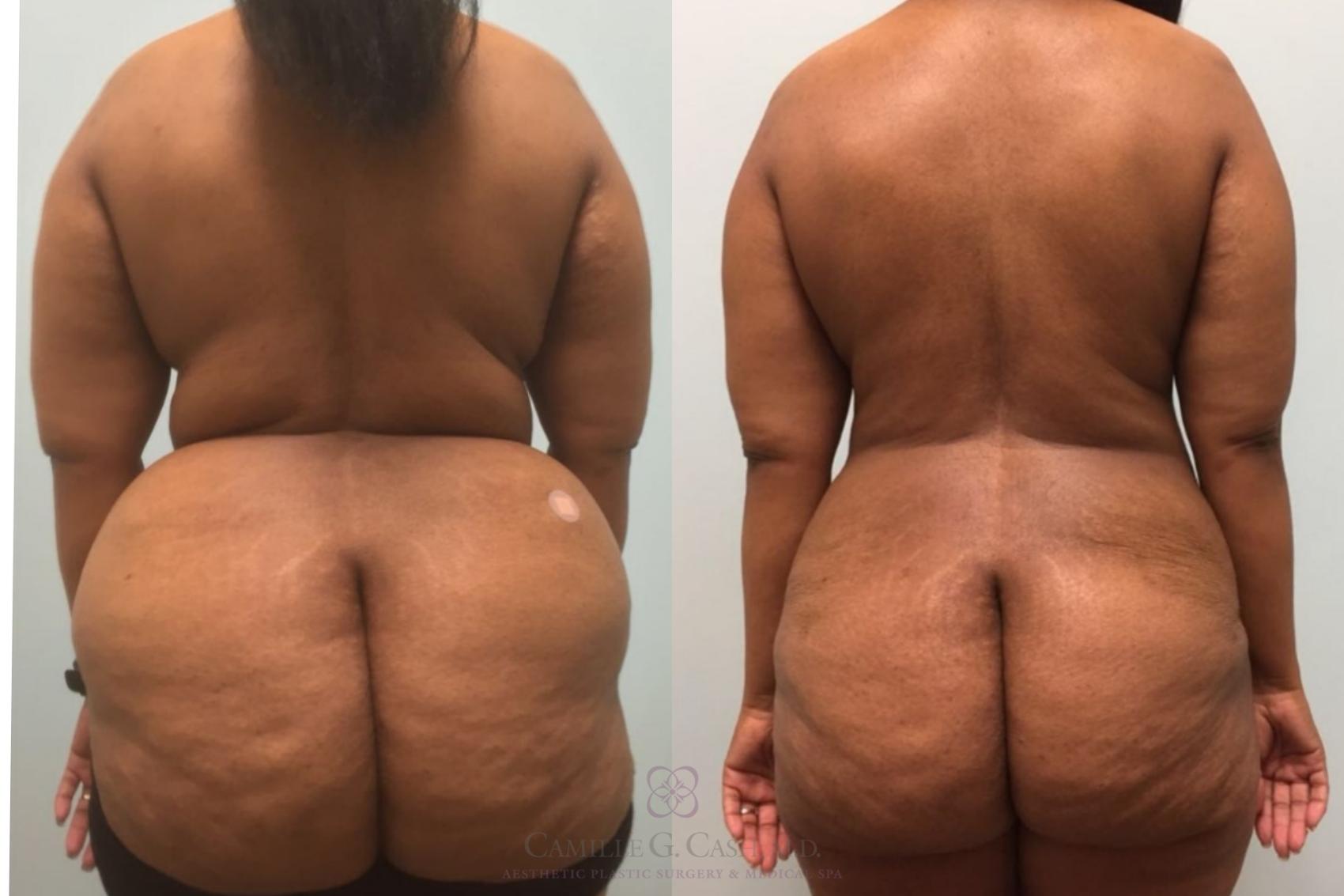 Before & After Tummy Tuck Case 181 Back View in Houston, TX