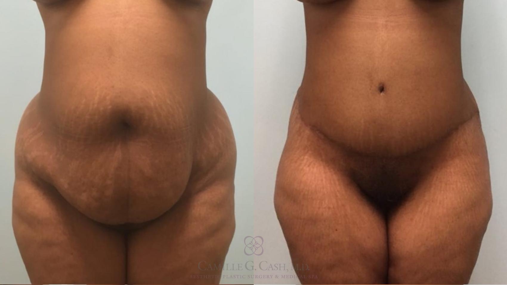 Before & After Tummy Tuck Case 181 front 4 View in Houston, TX