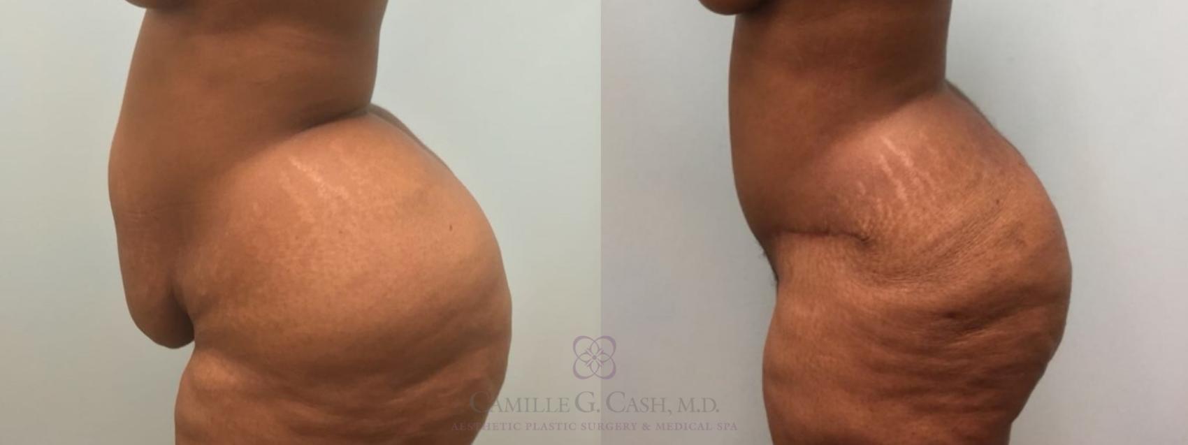 Before & After Tummy Tuck Case 181 Left Side View in Houston, TX