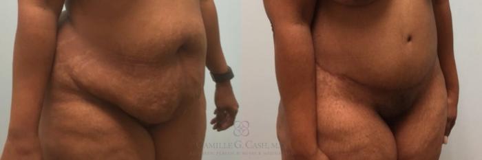 Before & After Tummy Tuck Case 181 Right Oblique View in Houston, TX