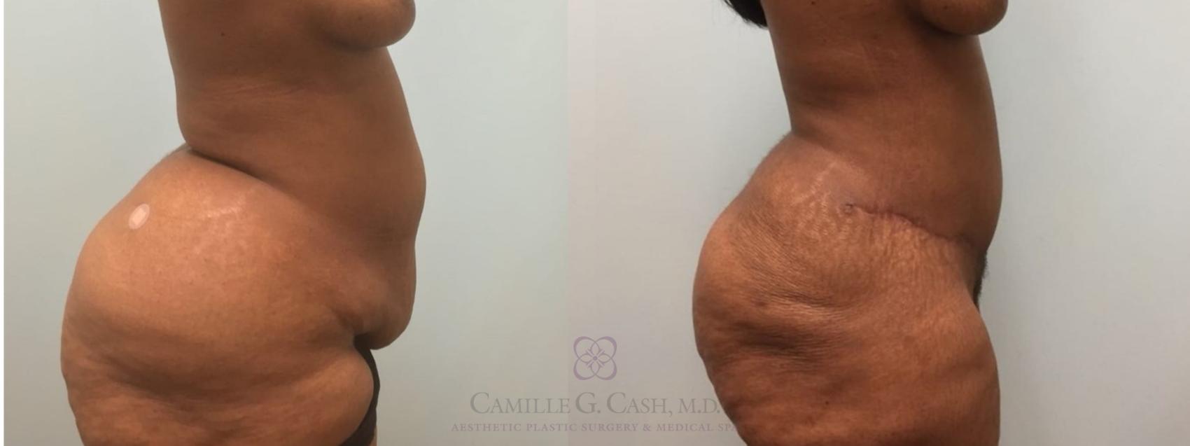 Before & After Tummy Tuck Case 181 Right Side View in Houston, TX