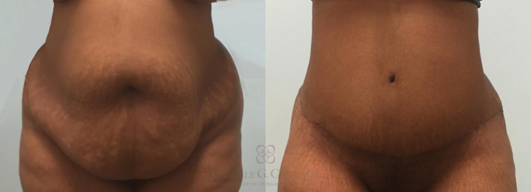 Before & After Tummy Tuck Case 181 View #1 View in Houston, TX