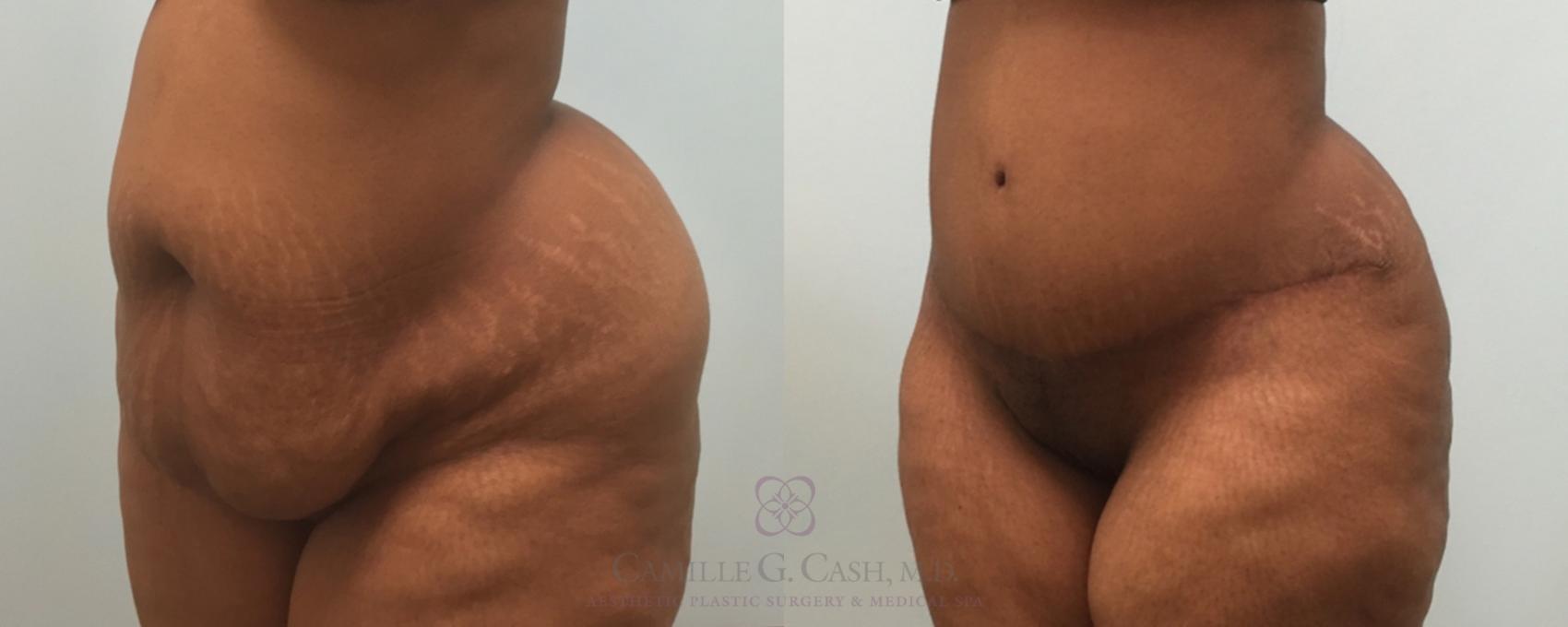 Before & After Tummy Tuck Case 181 View #2 View in Houston, TX