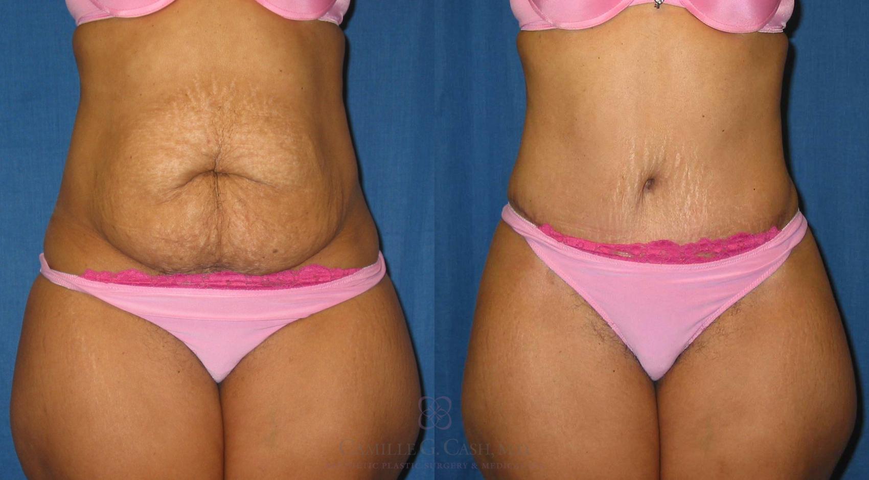 Before & After Tummy Tuck Case 184 View #1 View in Houston, TX