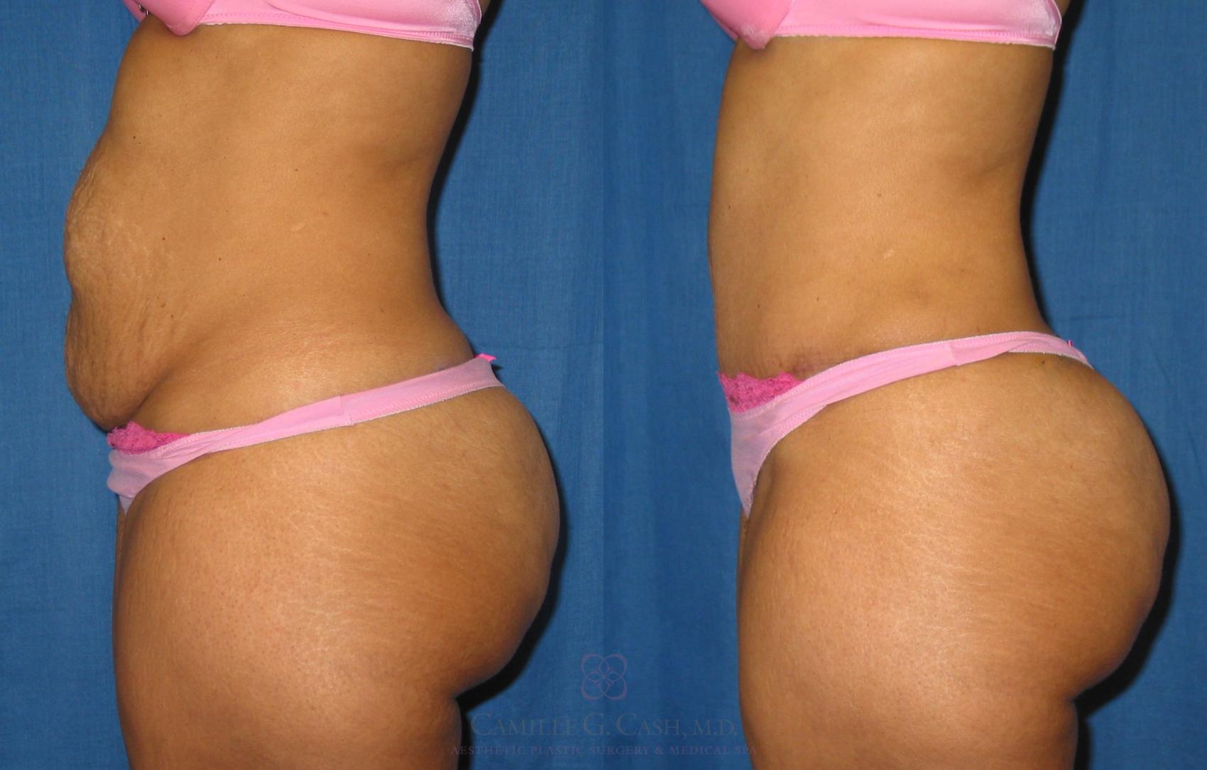 Before & After Tummy Tuck Case 184 View #2 View in Houston, TX