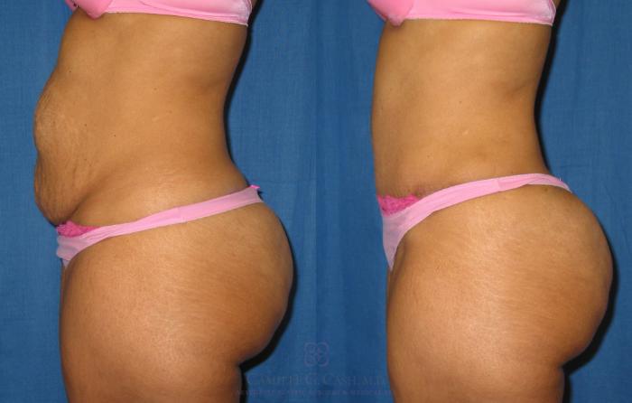 Before & After Tummy Tuck Case 184 View #2 View in Houston, TX