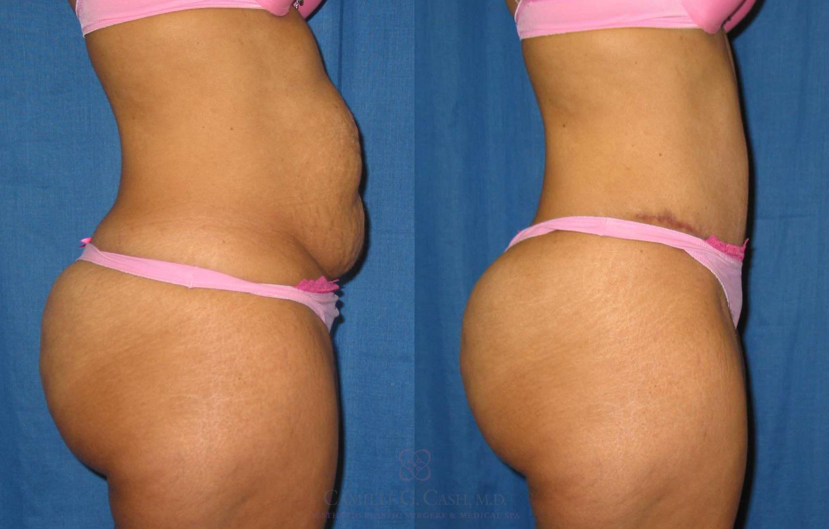 Before & After Tummy Tuck Case 184 View #3 View in Houston, TX