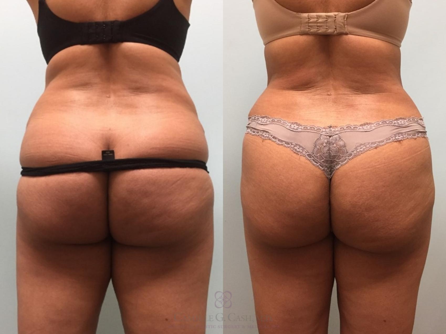 Before & After Tummy Tuck Case 203 Back View in Houston, TX