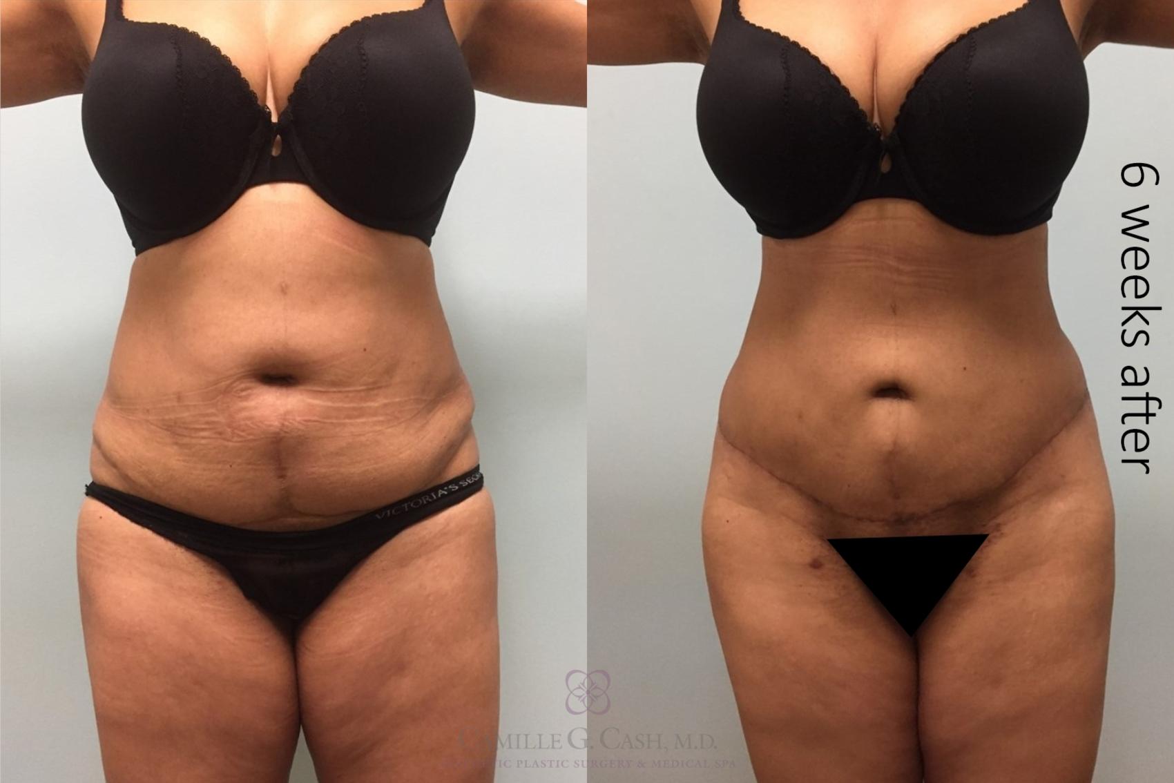 Before & After Tummy Tuck Case 203 Front View in Houston, TX