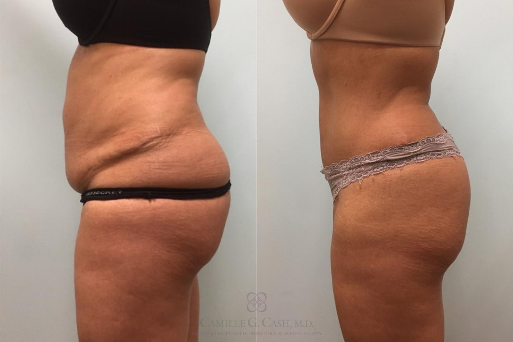 Before & After Tummy Tuck Case 203 Right Side View in Houston, TX