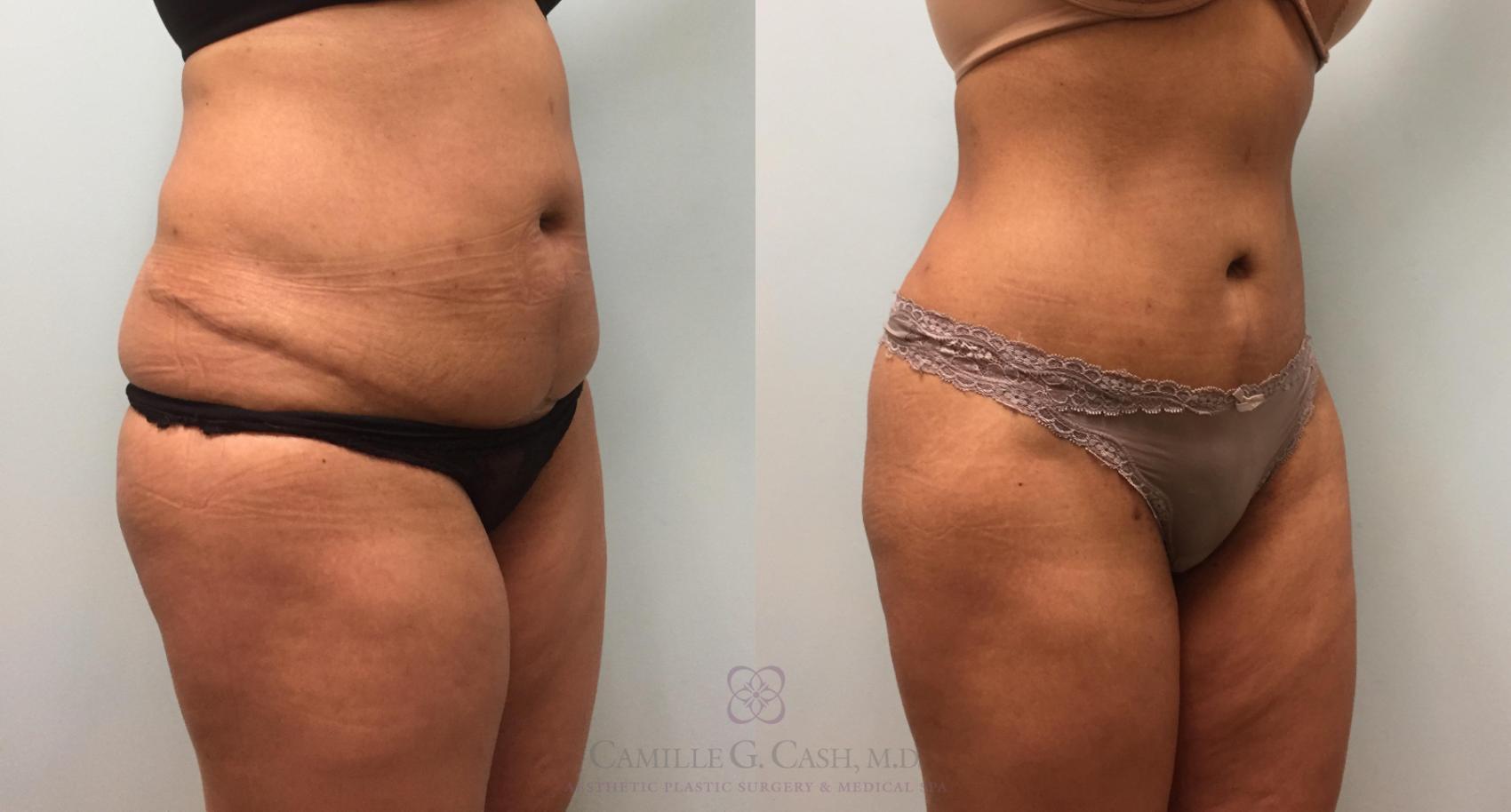 Before & After Tummy Tuck Case 203 View #2 View in Houston, TX