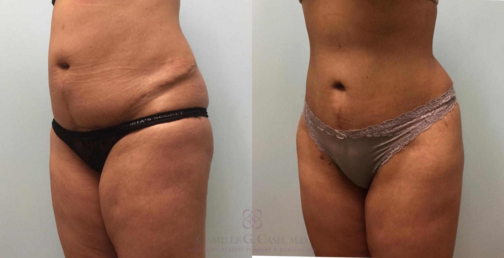 Before & After Tummy Tuck Case 203 View #3 View in Houston, TX
