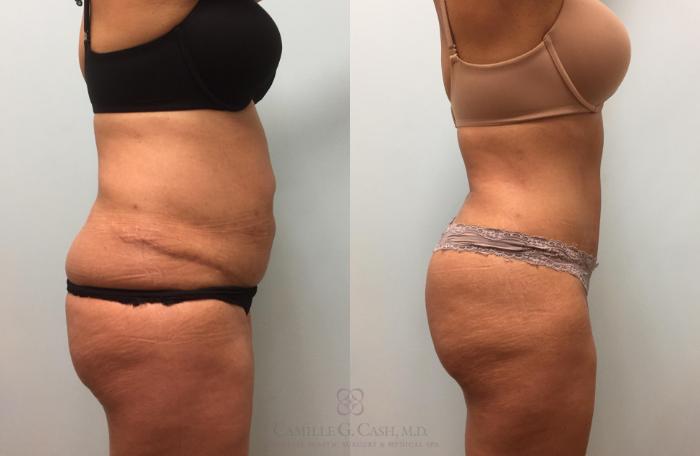 Before & After Tummy Tuck Case 203 View #4 View in Houston, TX