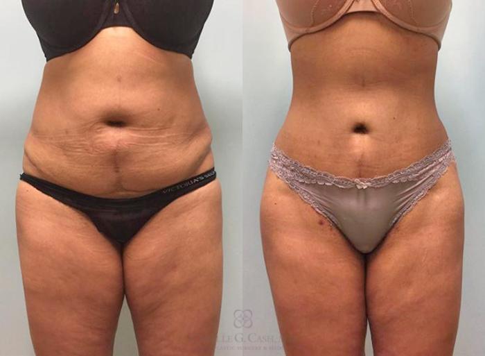 Before & After Tummy Tuck Case 203 View #5 View in Houston, TX
