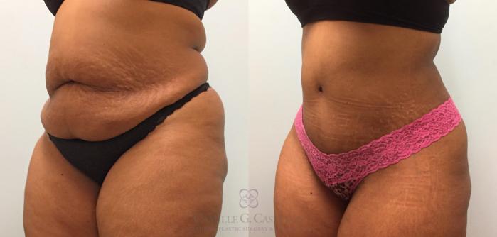 Before & After Tummy Tuck Case 209 View #2 View in Houston, TX