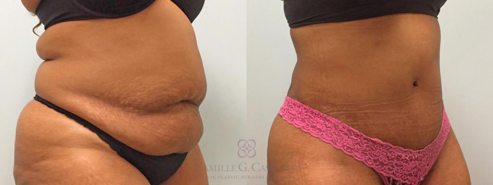 Before & After Tummy Tuck Case 209 View #3 View in Houston, TX