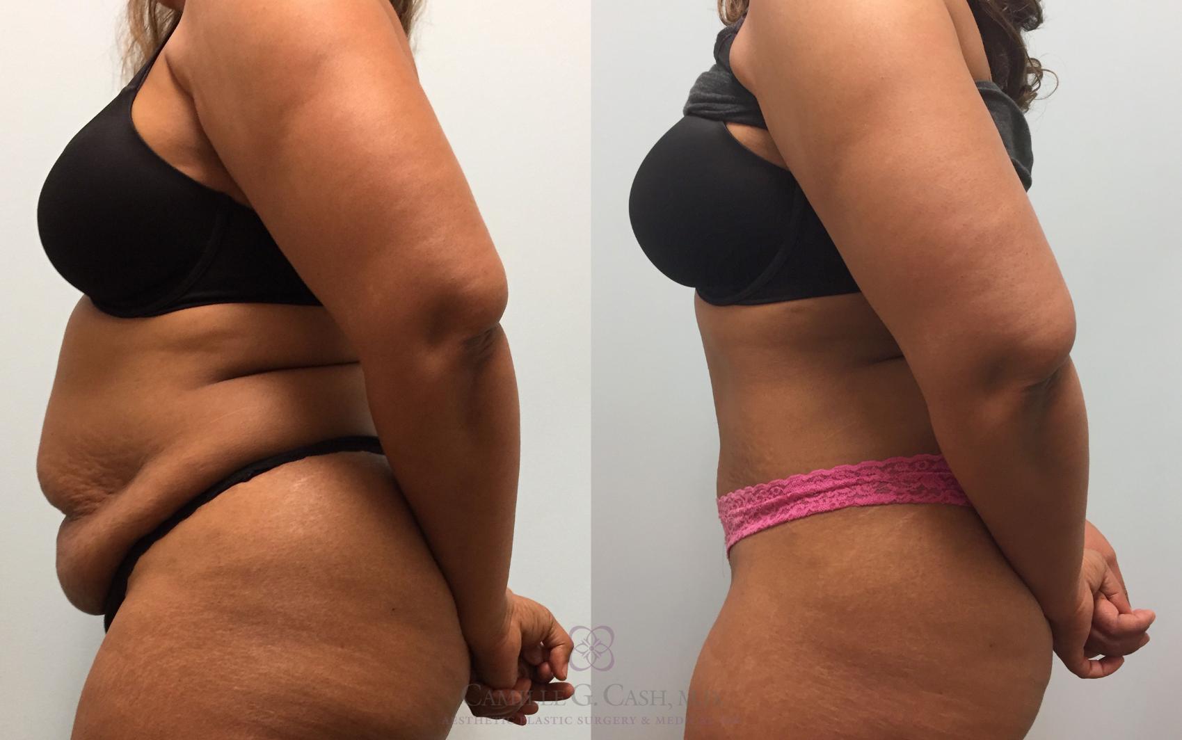 Before & After Tummy Tuck Case 209 View #4 View in Houston, TX