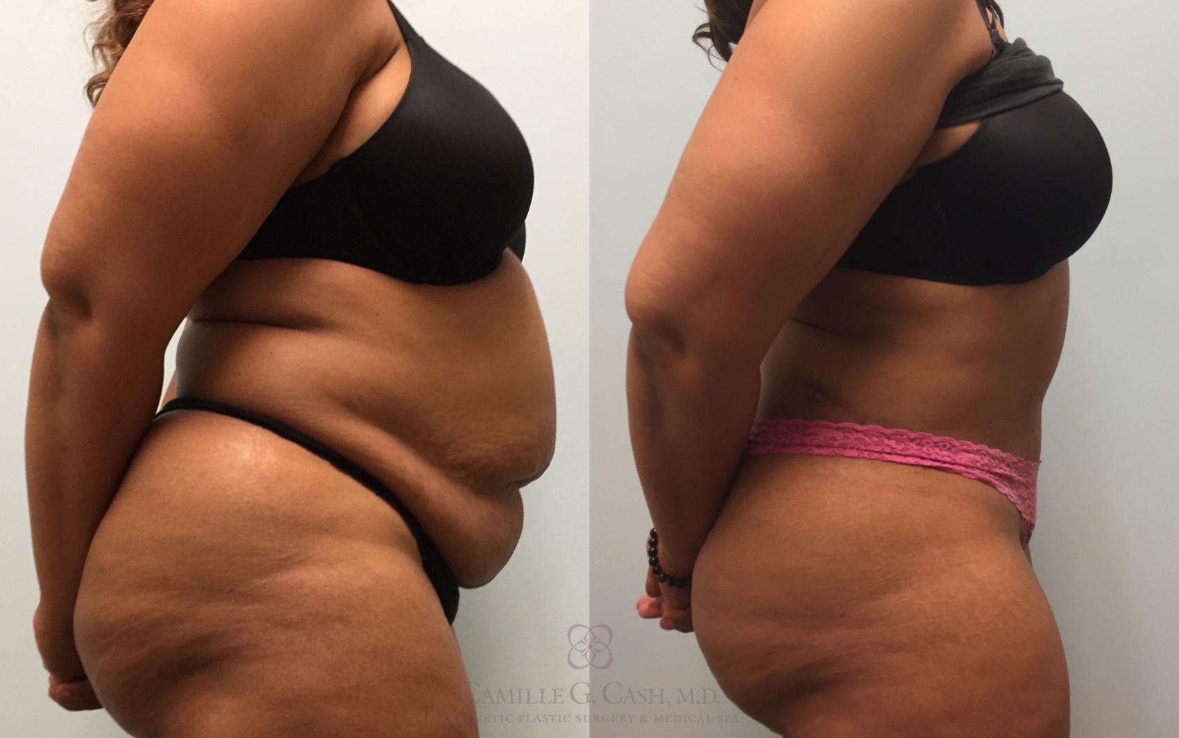 Before & After Tummy Tuck Case 209 View #5 View in Houston, TX