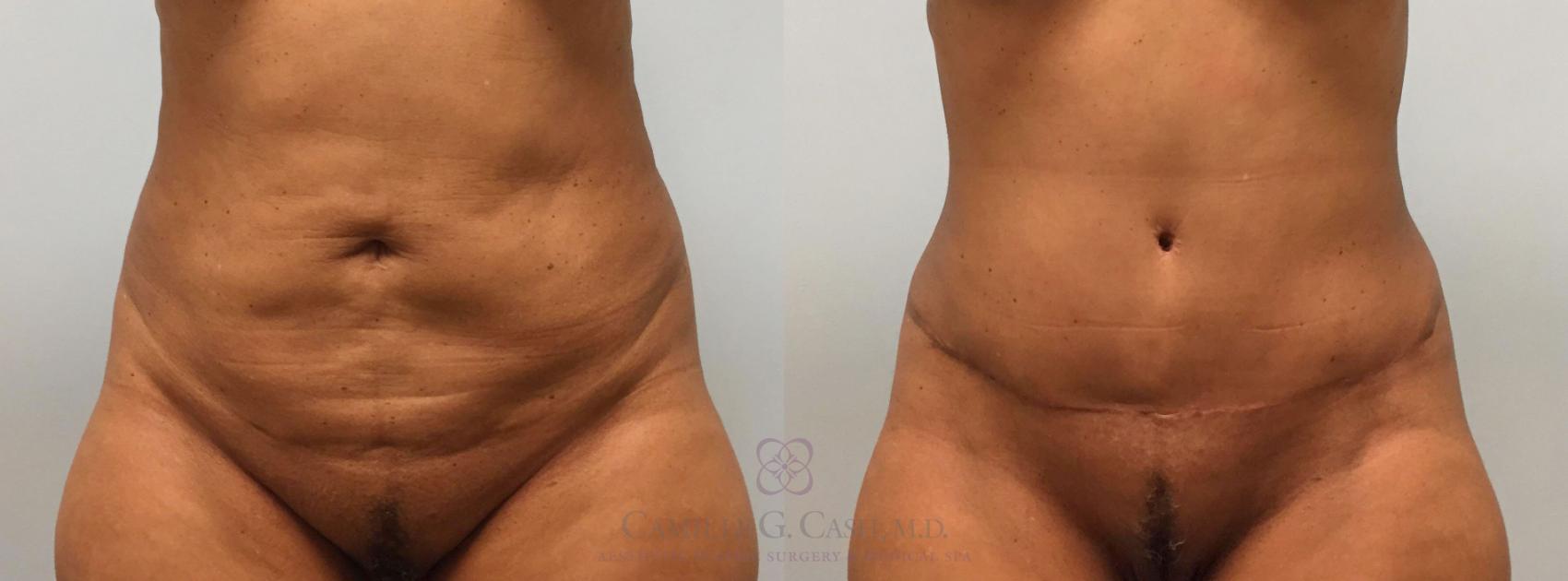 Before & After Tummy Tuck Case 216 View #1 View in Houston, TX