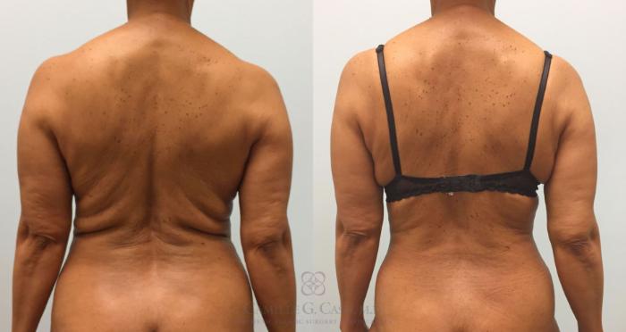 Before & After Tummy Tuck Case 216 View #2 View in Houston, TX