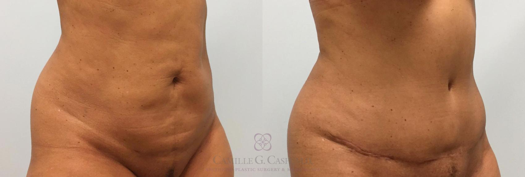 Before & After Tummy Tuck Case 216 View #3 View in Houston, TX