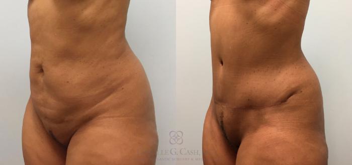 Before & After Tummy Tuck Case 216 View #4 View in Houston, TX