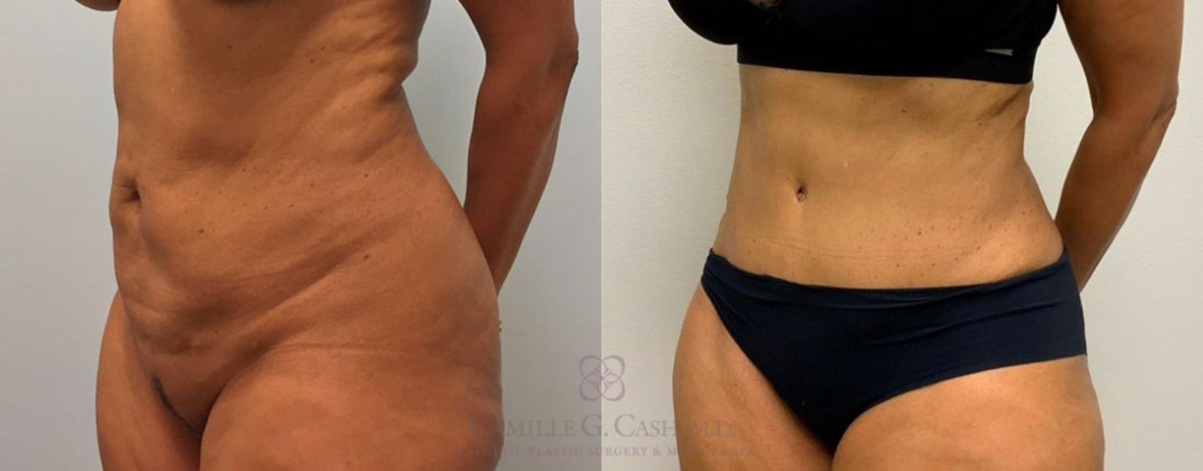 Before & After Tummy Tuck Case 216 View #5 View in Houston, TX