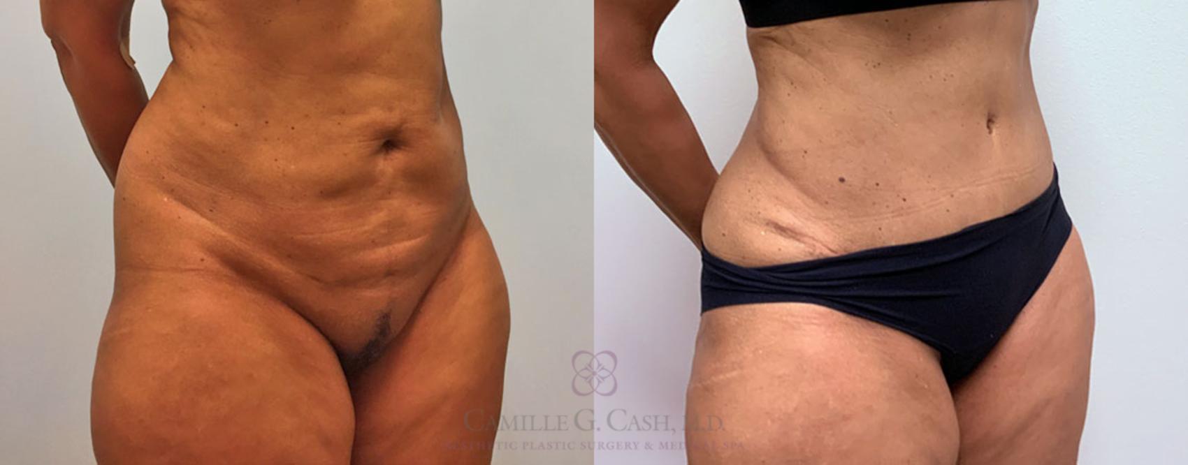 Before & After Tummy Tuck Case 216 View #6 View in Houston, TX